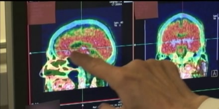 La demencia frontotemporal afecta más a los hispanos, según un estudio