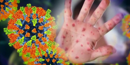 Los CDC reportan casi 2,600 contagios de sarampión, es la cifra más alta en tres décadas