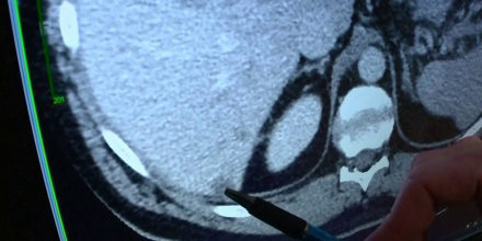 La FDA aprueba un nuevo medicamento para tratar el cáncer de páncreas