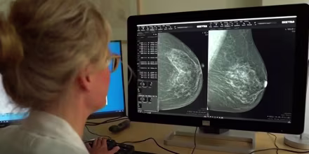 Estas son las señales de alerta que necesita tener en cuenta para la detección del cáncer de seno