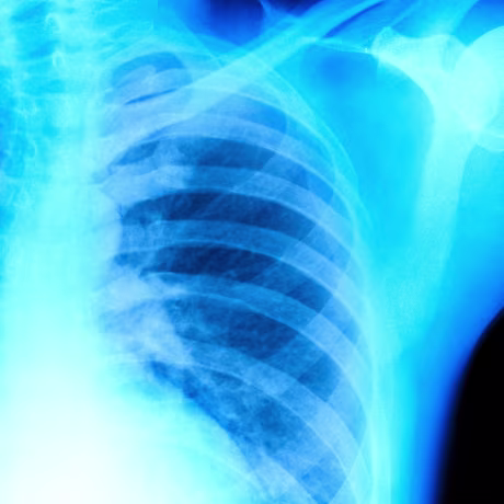 Chest x-ray showing lungs