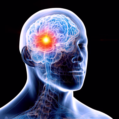 Human brain tumour, illustration