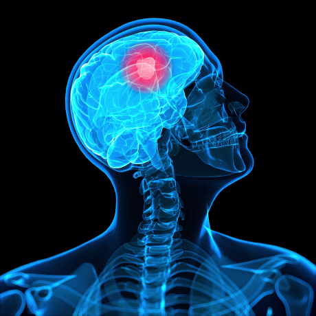 Brain cancer, artwork