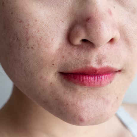 Cropped shot of woman having problems of acne inflamed on her face.