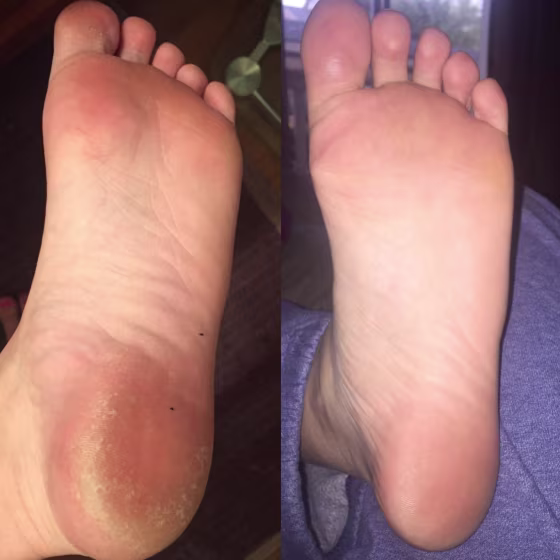 Exfoliant Foot Peel