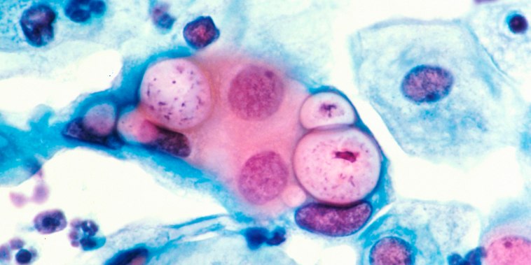 Image: A human pap smear showing chlamydia in the vacuoles.
