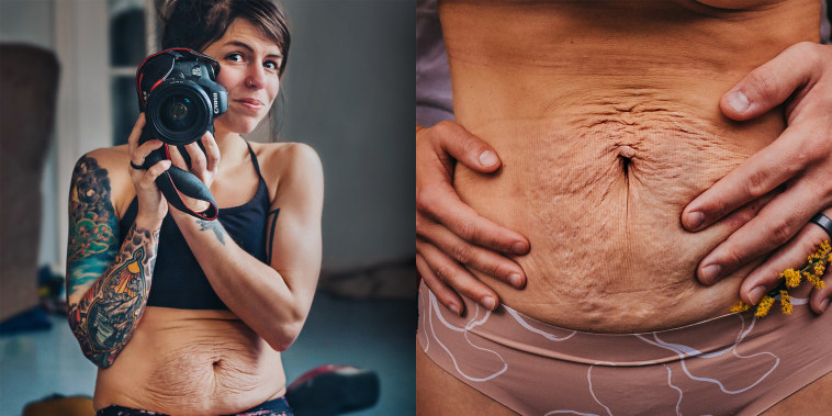 Hayley Garnett has been honest about her struggle with diastasis recti, a condition where abdominal muscles separate during pregnancy.