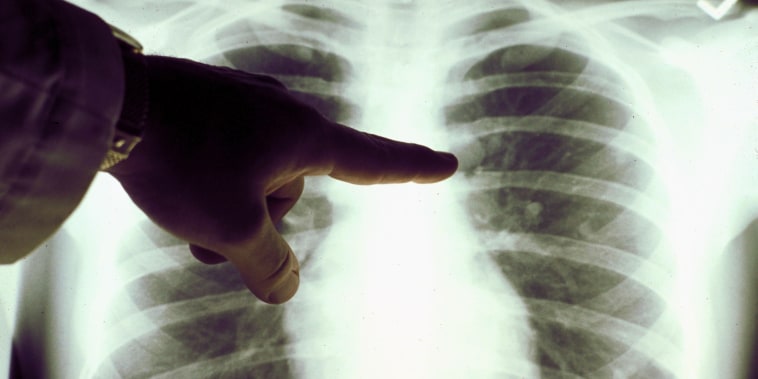 A close up of a lung x-ray of a cigarette smoker.