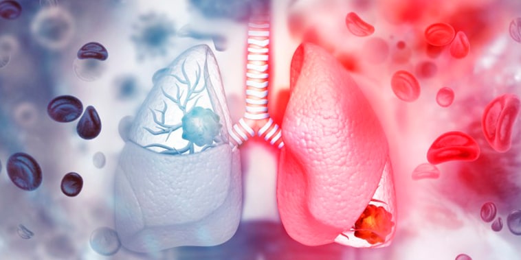Cáncer de pulmón