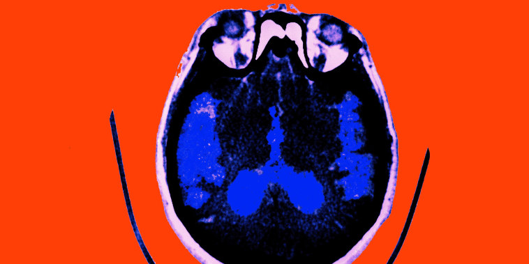 Image: Alzheimer'S Disease, Scan