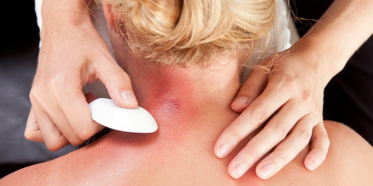 Above view of woman receiving gua-sha treatment on back.