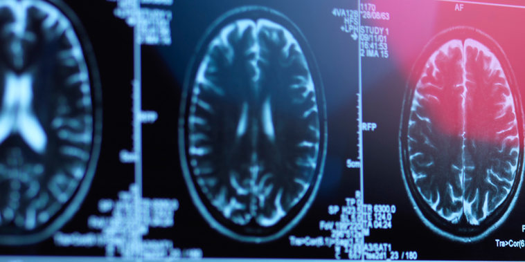 Doctor viewing brain scans
