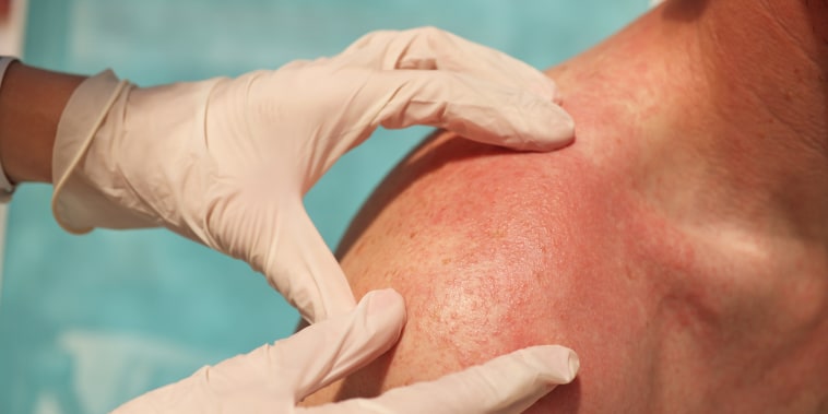 Doctor dermatologist examining rash on skin of man shoulders.