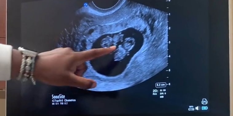 Ultrasound surprise