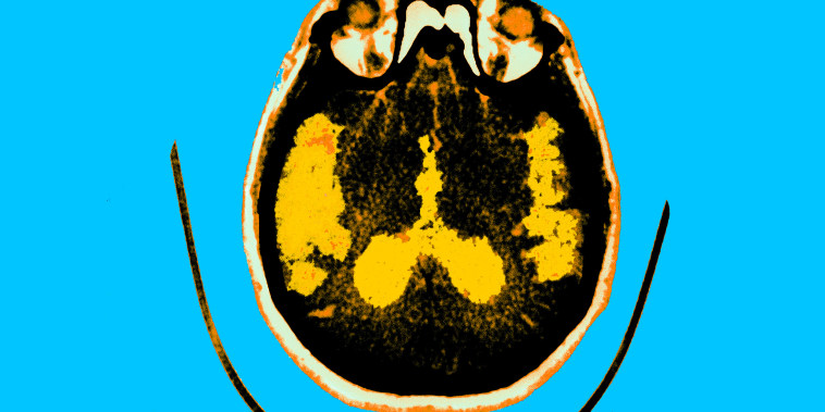 Axial section scan of the brain of a patient affected by Alzheimer's 