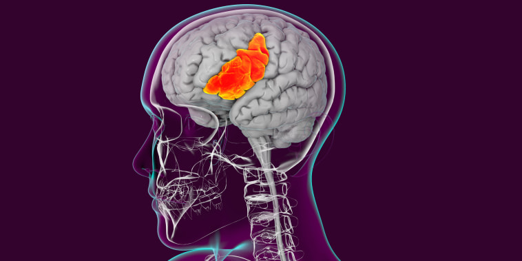 A human brain with highlighted inferior frontal gyrus