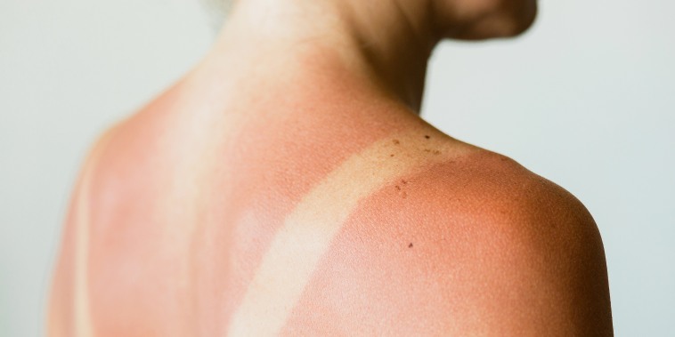 Close-up of a sunburn marks on a woman's back.
