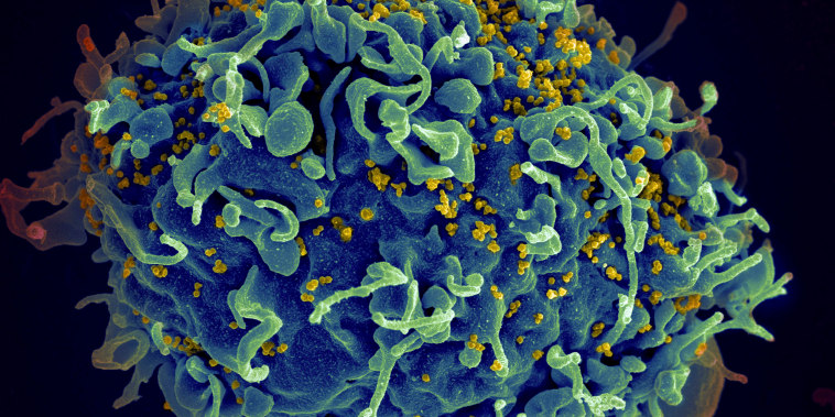 An electron microscope image shows a human T cell, blue, under attack by HIV, yellow, the virus that causes AIDS. 