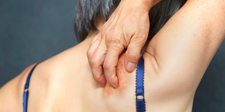 Woman with shingles