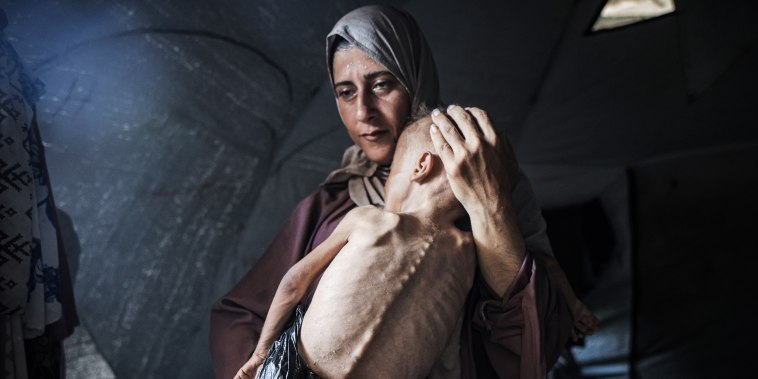 DO NOT USE - max

Muhammad Zakariya Ayyoub al-Matouq, a 1.5-year-old child in Gaza City, Gaza, faces life-threatening malnutrition as the humanitarian situation worsens due to ongoing Israeli attacks and blockade, on July 21, 2025.