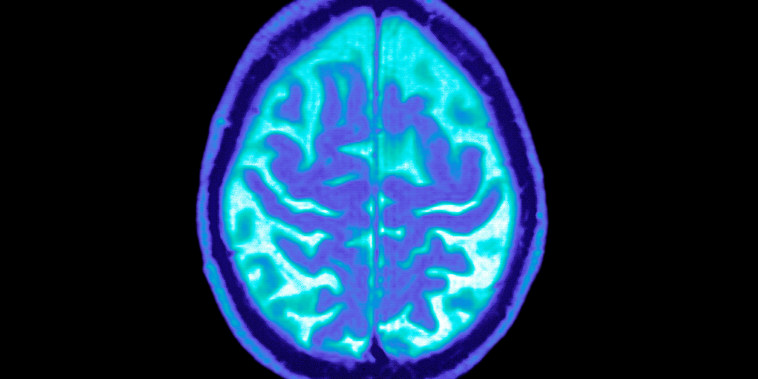 Alzheimer Disease, Mri brain scan