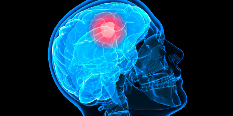 Brain cancer, artwork