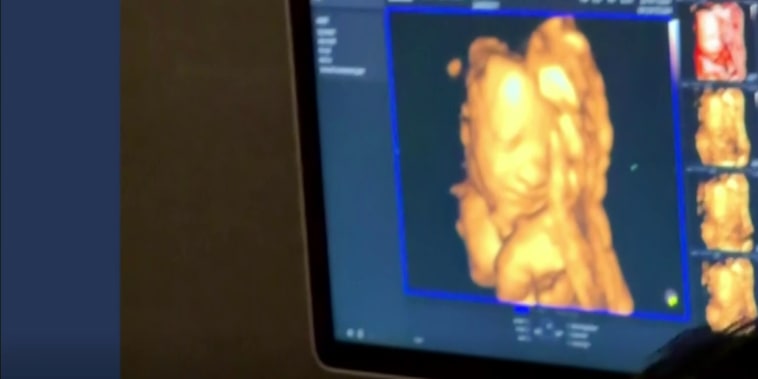 Un ultrasonido capta el momento en que una bebé sonríe a su papá