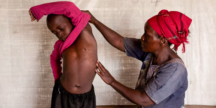Fideline Kiza Kasao, left, checks her son for mpox