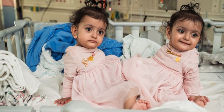 15-Month-Old Conjoined Twins Separated in Rare Surgery. See How They're Doing Now