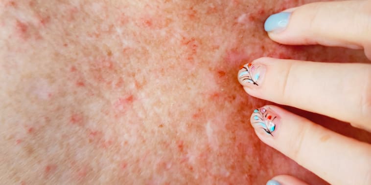 A Dermatologist’s 1 Simple Tip for Treating Heat Rash This Summer