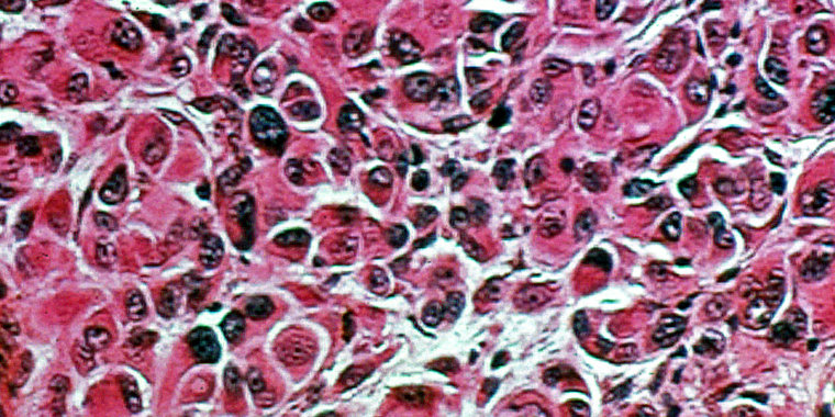 A melanoma biopsy.