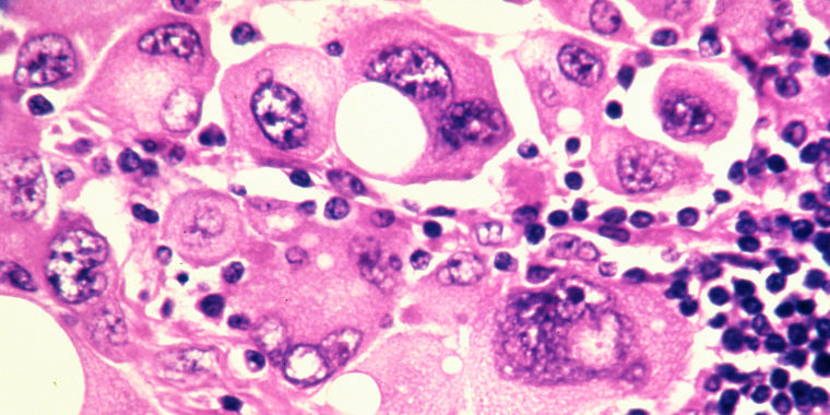 Human metastatic melanoma cells