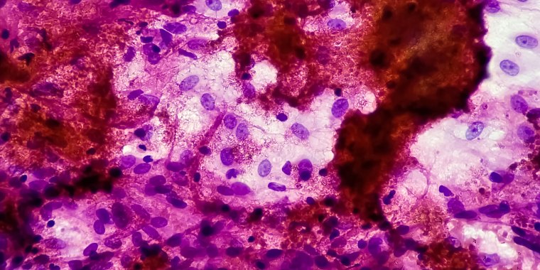 FNAC of lymph nodes tissue Cytology microscopic 100x show Microbacterium Tuberculosis TB. Lymph node TB.