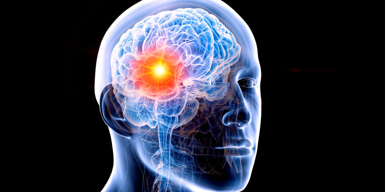 Human brain tumour, illustration
