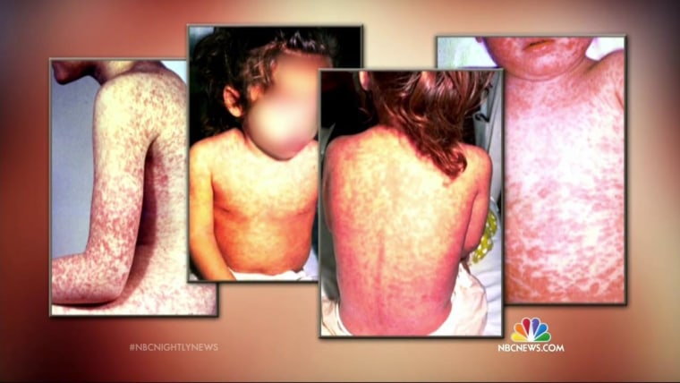 Disneyland-Linked Measles Outbreak Continues to Grow