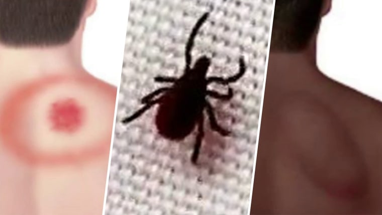 Symptoms of the Powassan virus of the mother of the child infected by the tick bite 1657026150303 tdy health 8a torres ticks lyme disease 220705 1920x1080 h432hj