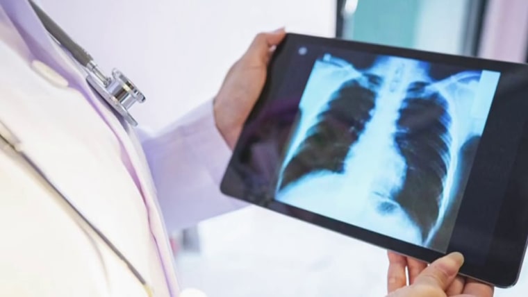 Who should get yearly lung cancer test, based on new guidelines