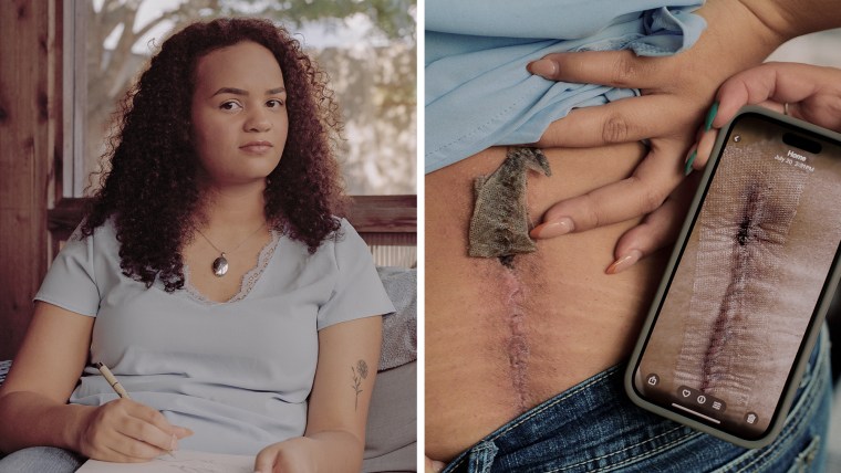 A split composite image of Nala White seated on a couch, left, and her lifting up her shirt to reveal scars on her back next to a phone showing a photo of said scar