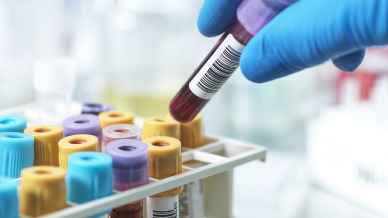 Hand of pathologist holding a blood sample in test tube at laboratory