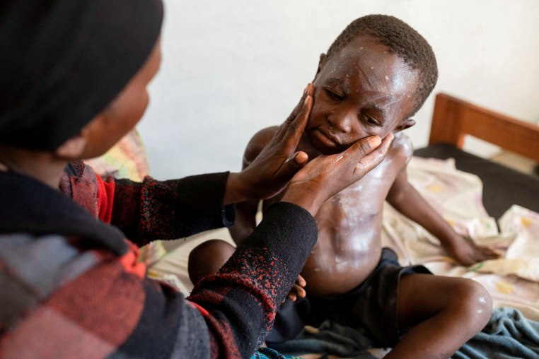 Mpox surge in Central Africa exposes awareness gap