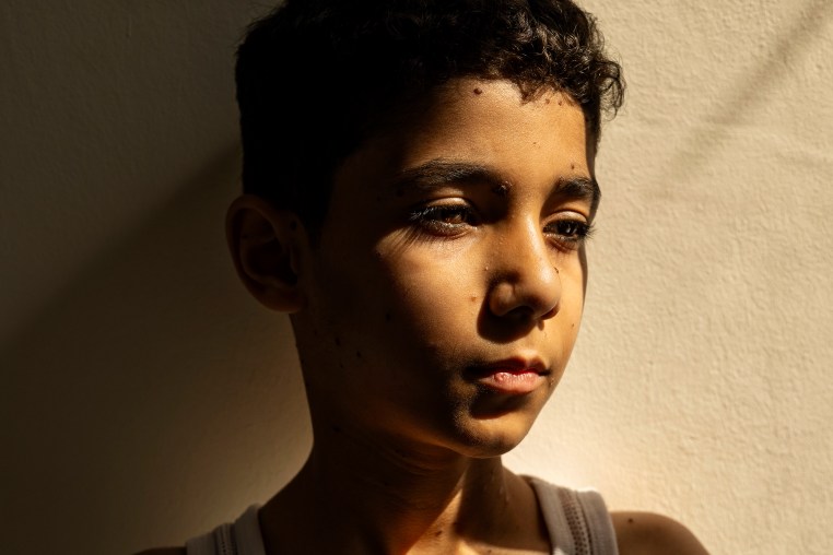 world press photo winner Mahmoud Ajjour (9), who was injured during an Israeli attack on Gaza City in March 2024, finds refuge and medical help in Qatar. Doha, Qatar, 28 June 2024.