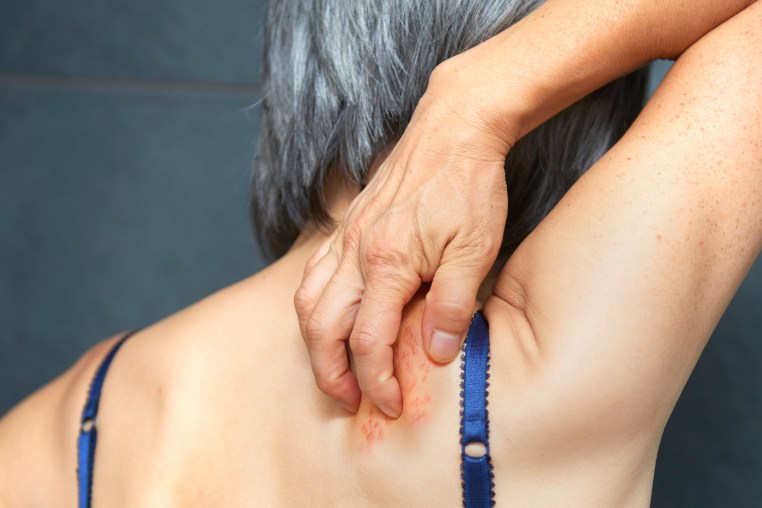 Woman with shingles