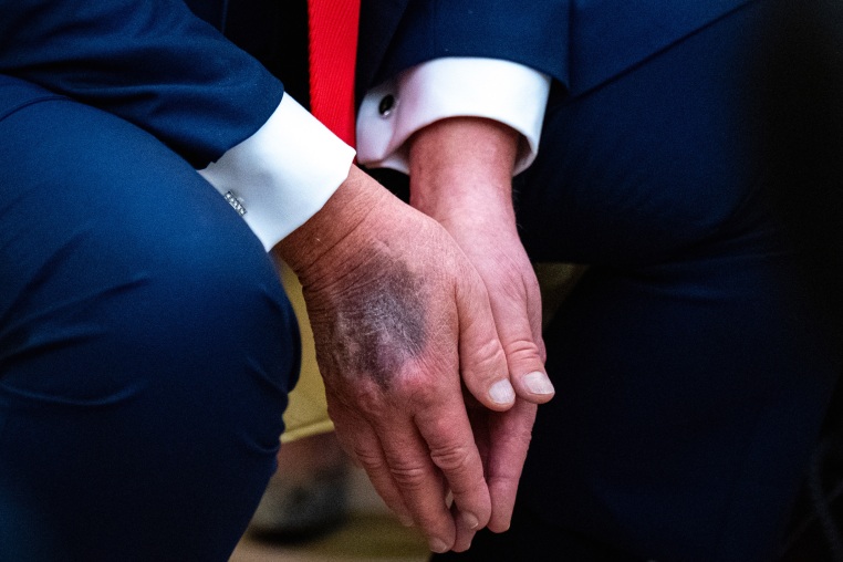 Trump's bruised hand