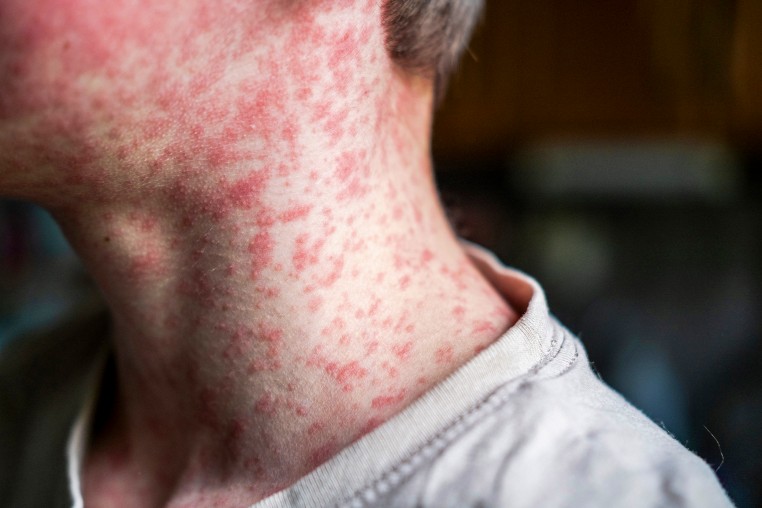 Skin covered with measles rash.