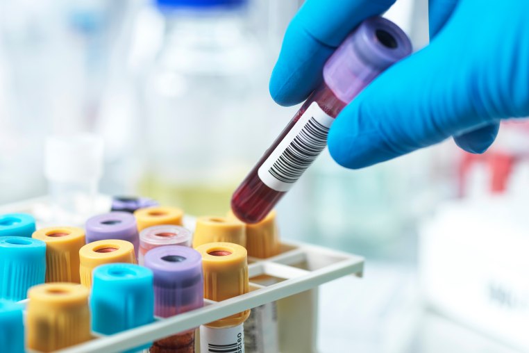 Hand of pathologist holding a blood sample in test tube at laboratory
