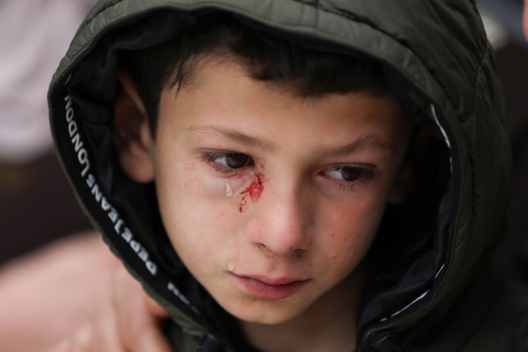 Mustafa Bani Odeh cries, an injury is seen below his eye