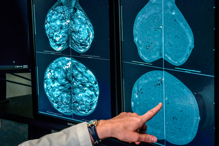 A doctor looks at mammogram imagery.
