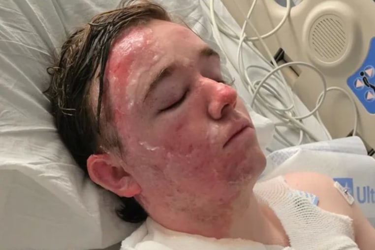 Jacob Smith recovers in the UC Davis ICU burn unit after police say a coworker at a McDonald's in Yuba City, Calif., threw hot liquid on him.