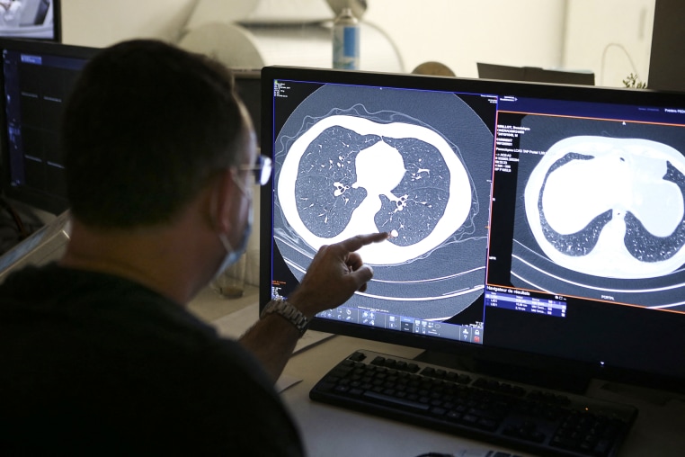 A doctor points at a lung cancer scan on a computer screen while seated at a desk in a doctor's office