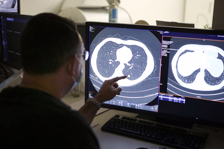 A doctor points at a lung cancer scan on a computer screen while seated at a desk in a doctor's office